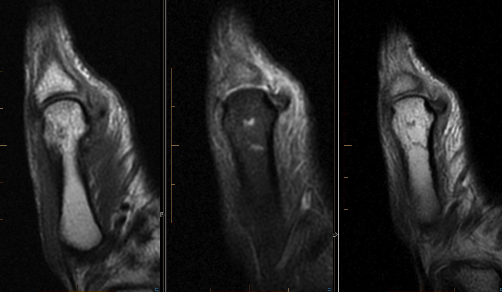 Figure 2 for case stener lesion
